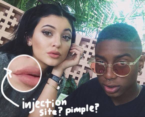 Kylie Jenner Addresses Lip Injection Rumors-1027-2