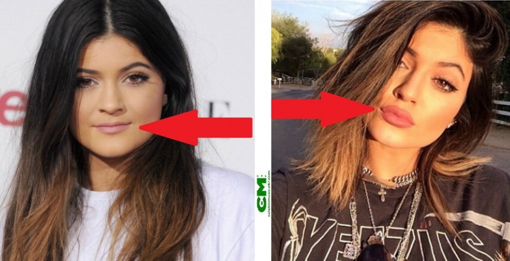 Kylie Jenner Addresses Lip Injection Rumors-1027-3