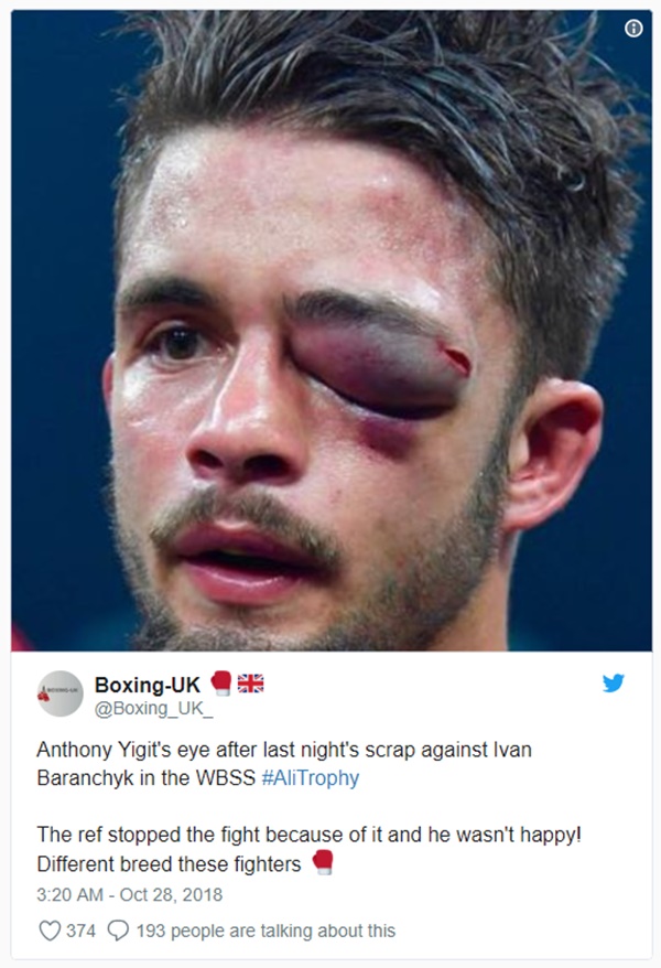 Boxer Anthony Yigit Eye Injury Swells to Size of Baseball