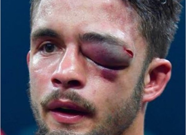 Boxer Anthony Yigit Eye Injury Swells to Size of Baseball