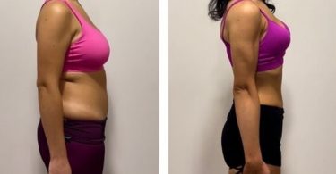 Struggling With Stubborn Fat? Why Mitolyn Is The Weight Loss Breakthrough